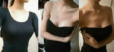 隆胸后术后2个月照片