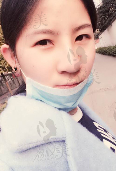 高颜值秘诀记录在上海美联臣整形医院做假体隆鼻变美过程