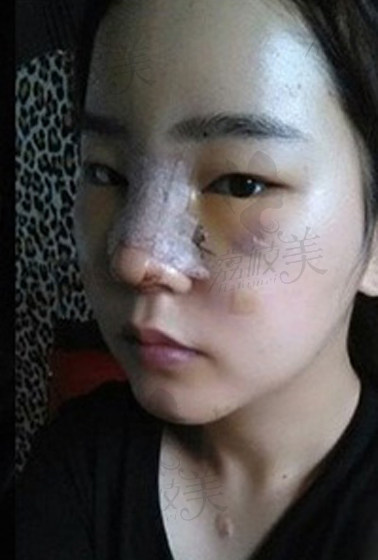 在北京艾玛整形医院找李方奇医生做的假体隆鼻,效果非常赞!