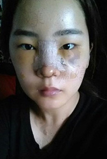 在北京艾玛整形医院找李方奇医生做的假体隆鼻,效果非常赞!