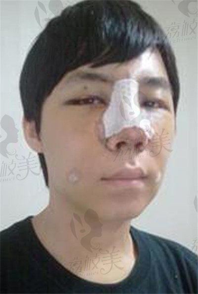 韩国清潭FIRST整形立体旋翼鼻+开眼角+脂肪填充,术后对比照！