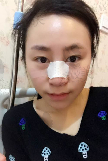韩国清潭FIRST整形医院做的立体旋翼鼻术后1-7天恢复效果图！