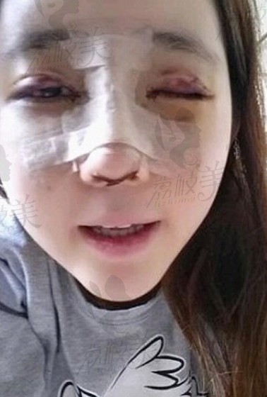 赴韩国整形做的胎式无痕双眼皮+隆鼻手术,看看效果怎么样 ?