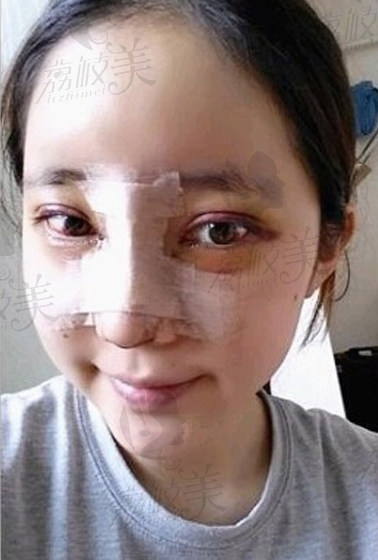 赴韩国整形做的胎式无痕双眼皮+隆鼻手术,看看效果怎么样 ?