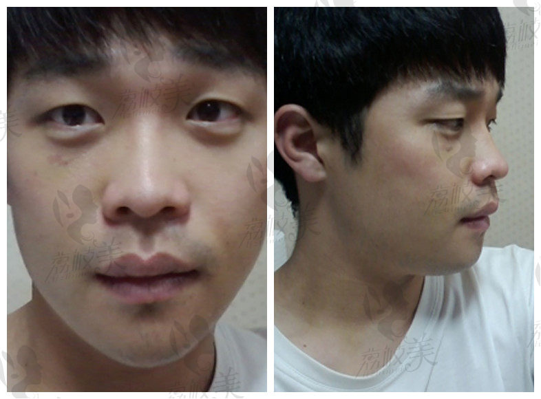 韩国id整形医院注射隆鼻+切除下颌角,现实版的青蛙变王子！