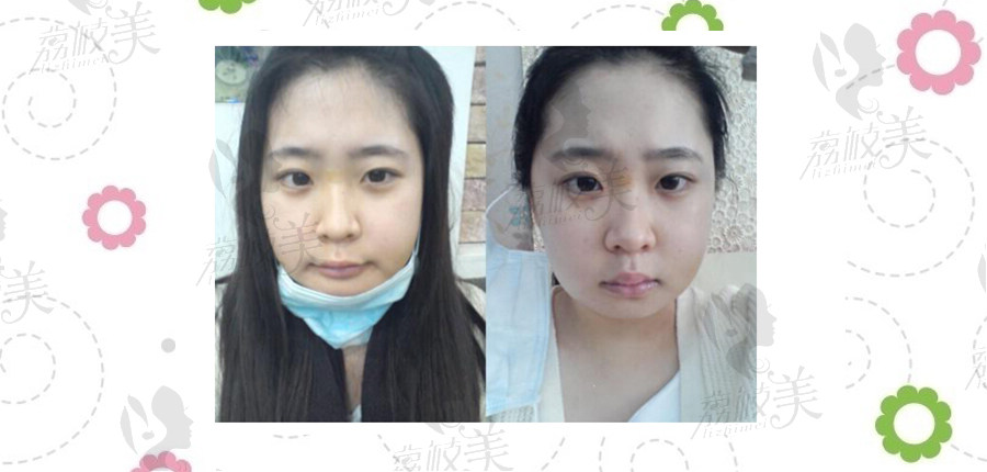 韩国id整形医院双颚整形手术真实案例，术后效果对比照！