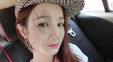 美丽无极限假体隆鼻+下巴整形+开眼角术后1-7天恢复效果图！
