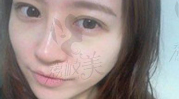赴韩整形选择做瘦脸+隆鼻手术,给大家分享我的赴韩整容经历