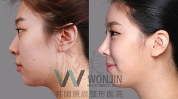 27岁辛小姐在韩国原辰整形医院做的面部 手术整形案例！