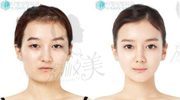 韩国TL整形医院-面部轮廓整形案例,术后效果对比图！
