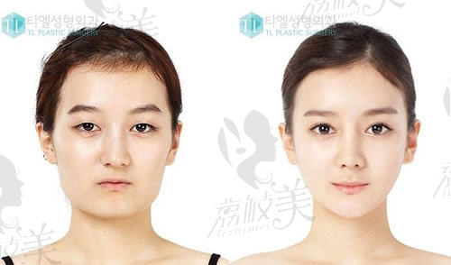 更美丽：韩国TL整形医院-面部轮廓整形案例