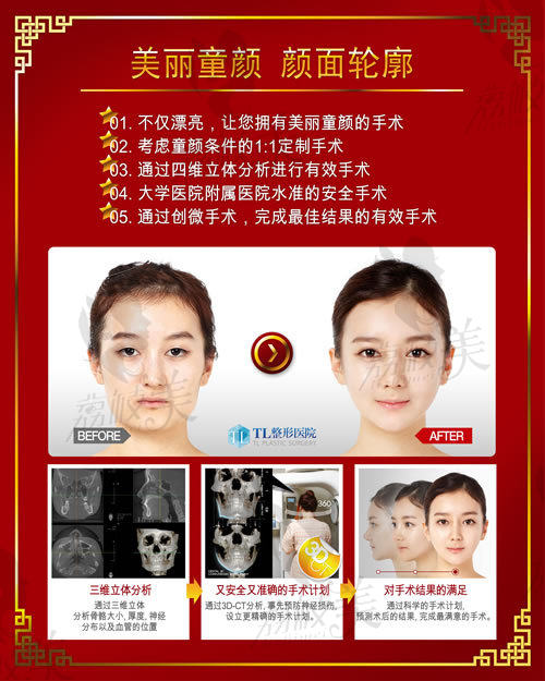 更美丽：韩国TL整形医院-面部轮廓整形案例