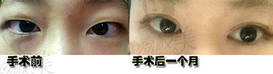 更美丽：（多图）留学生在韩国贝缇莱茵做双眼皮整形经历
