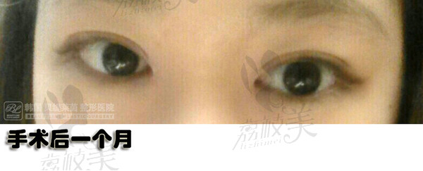 更美丽：（多图）留学生在韩国贝缇莱茵做双眼皮整形经历