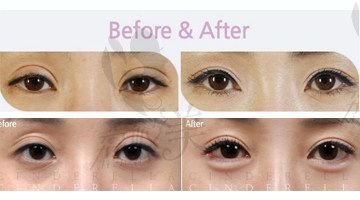 韩国双眼皮修复医院，哪个医院修复双眼皮效果