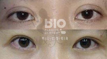 韩国哪个眼睛修复医生修复效果更好更自然？