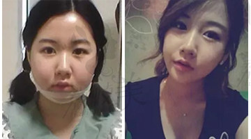 韩国ID整形李知赫做的颌面整形，术后歪嘴变脸过程展示