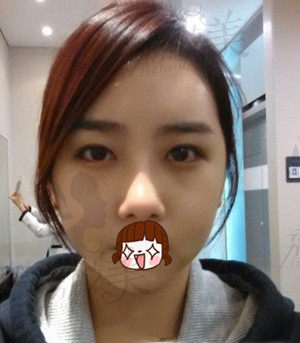 更美丽：颧骨+下颌角+脂肪填充 不要被我吓到