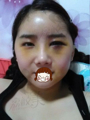 更美丽：颧骨+下颌角+脂肪填充 不要被我吓到