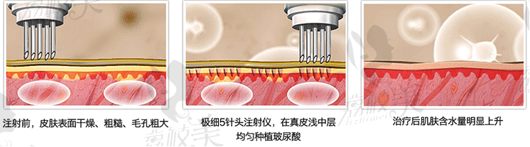  你注射原理