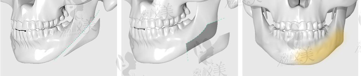 下颌角手术