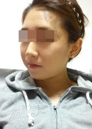在韩国做的小切口提升除皱手术,感觉年轻了很多，秒变少女!