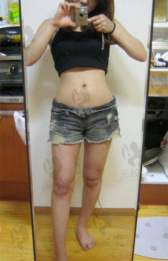 在韩国faceline整形医院做的腹部吸脂手术,来看术后效果对比!