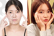 在韩国TL整形医院做脸部综合手术后，成为 女神了！
