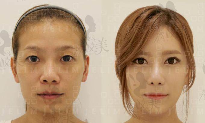 一位被叫“ET女”的心酸整形故事