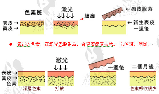 激光祛斑原理示意图