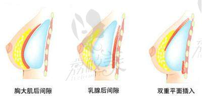 假体隆胸植入位置示意图