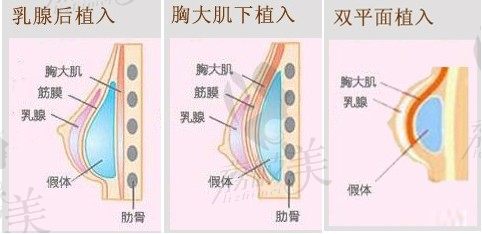 假体隆胸示意图