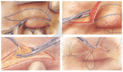 双眼皮手术示意图