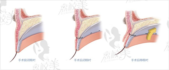 双眼皮原理示意图