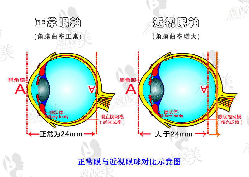 近视眼手术原理