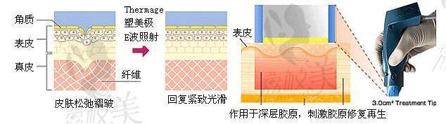 電波拉皮示意圖