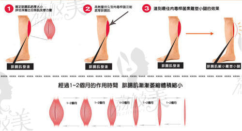 瘦腿针原理示意图