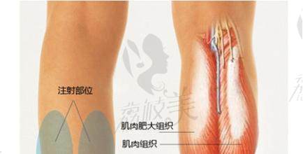 瘦腿针注射示意图