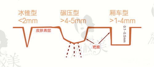 不同类型痘坑示意图