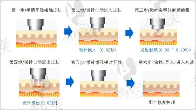 黄金微针治疗原理示意图