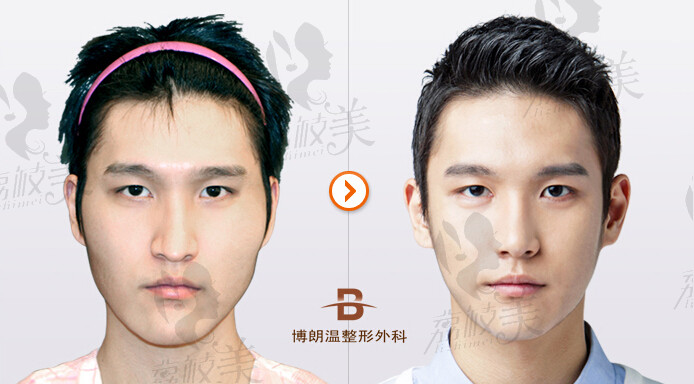 韩国面部轮廓手术对比案例