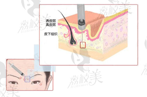  素注射原理示意图