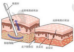 吸脂原理