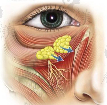 脂肪在定位眼袋整形手术