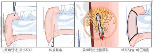 吸脂手术过程示意图