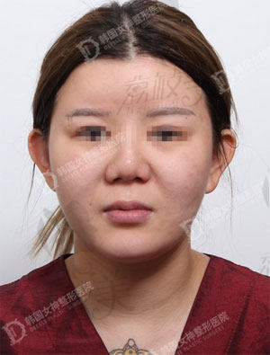韩国女神整形吸脂术前面部照片