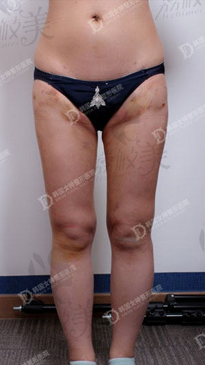 韩国女神整形腿部吸脂术后十天照片