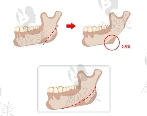 下颌角手术示意图