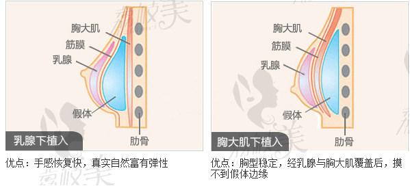 假体隆胸示意图