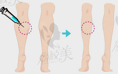 瘦腿针注射